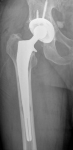 The image displays an X-ray of a patient's hip